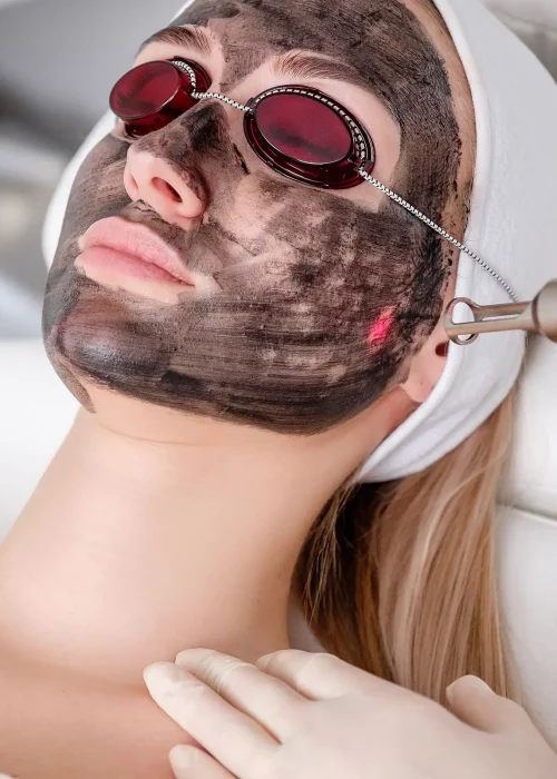 Carbon-Laser-Facial-Hollywood-Facial